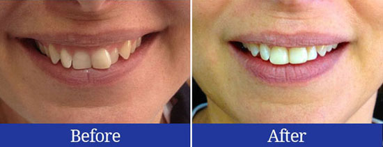 Before and after results of straightening crowded teeth