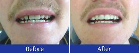 Before and after results of closing spaced teeth