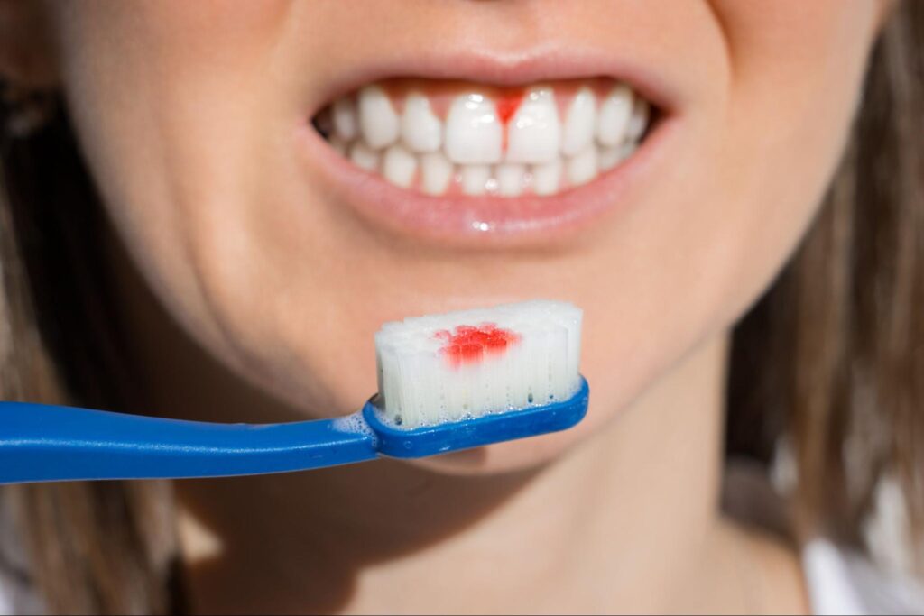 Why Gums are Bleeding When Brushing Teeth